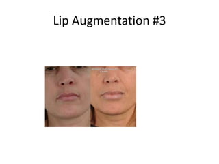 Lip Augmentation #3
 