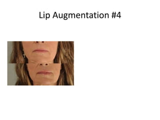Lip Augmentation #4
 
