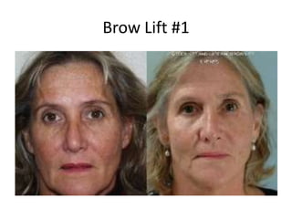 Brow Lift #1
 