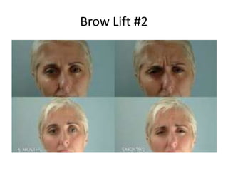 Brow Lift #2
 