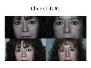Cheek Lift #1
 