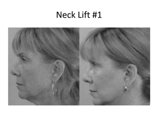 Neck Lift #1
 