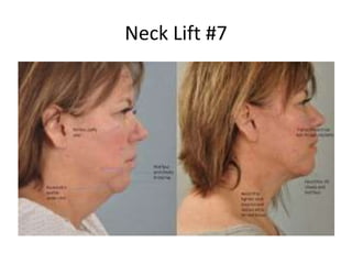 Neck Lift #7
 