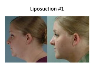 Liposuction #1
 