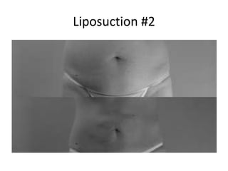 Liposuction #2
 