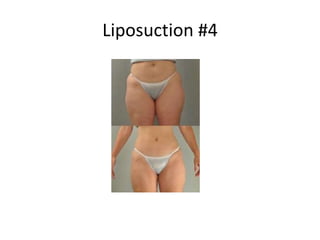 Liposuction #4
 