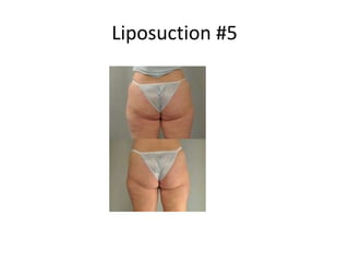 Liposuction #5
 