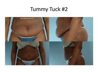 Tummy Tuck #2
 