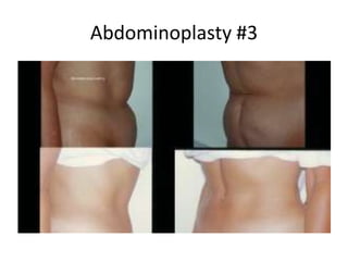 Abdominoplasty #3
 