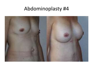 Abdominoplasty #4
 