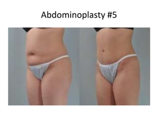 Abdominoplasty #5
 