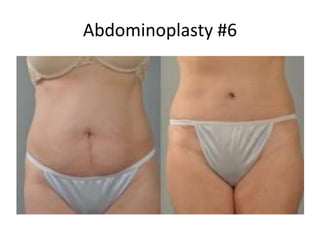 Abdominoplasty #6
 