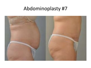 Abdominoplasty #7
 