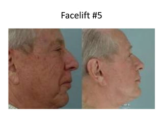 Facelift #5
 
