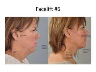 Facelift #6
 