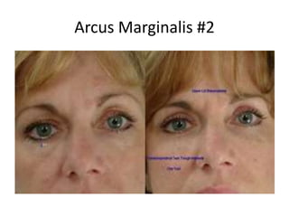 Arcus Marginalis #2
 