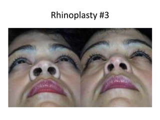 Rhinoplasty #3
 
