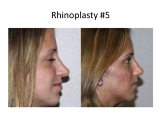Rhinoplasty #5
 