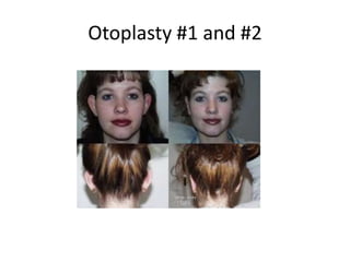 Otoplasty #1 and #2
 