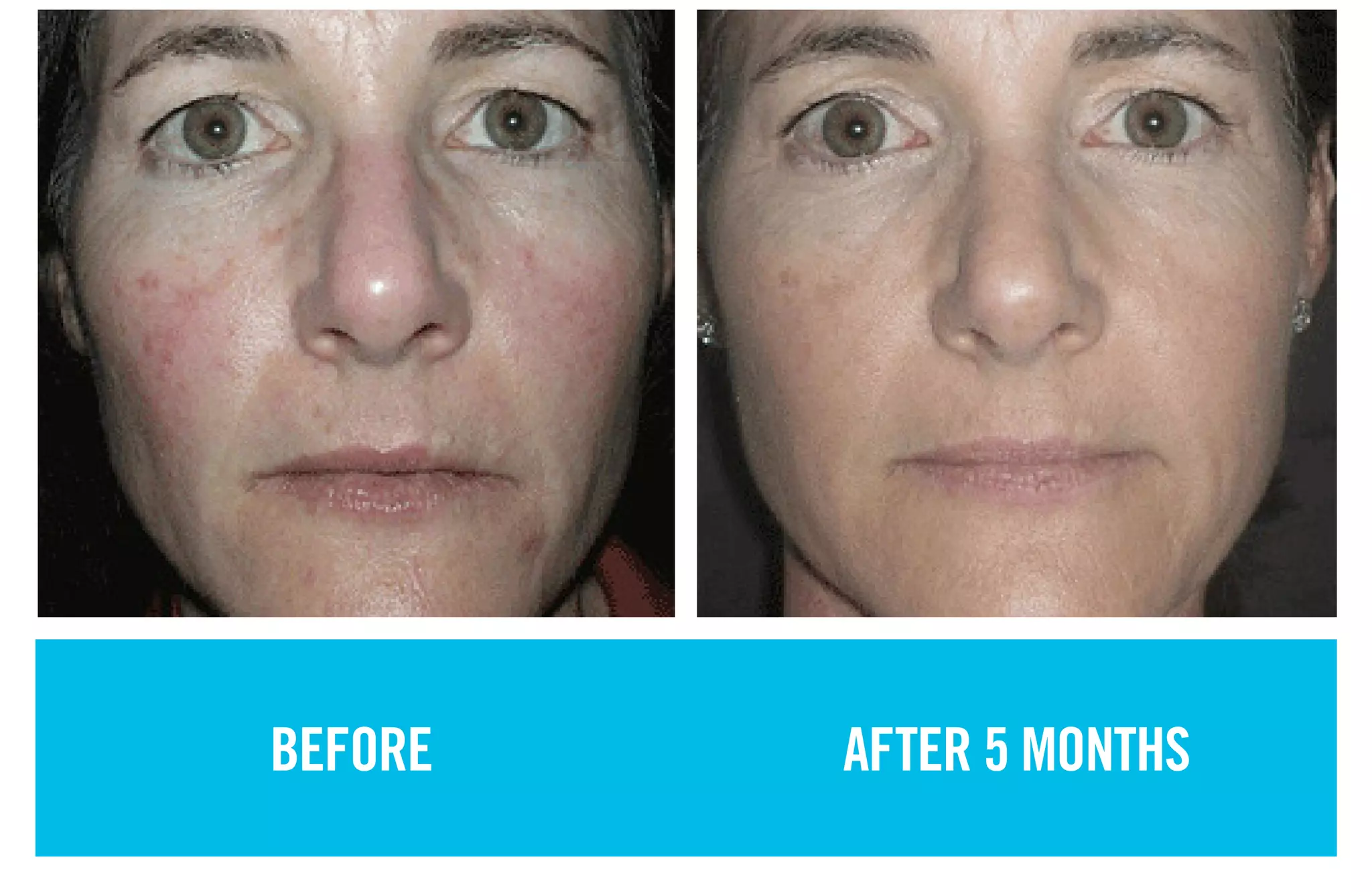 BEFORE AFTER 5 MONTHS
 