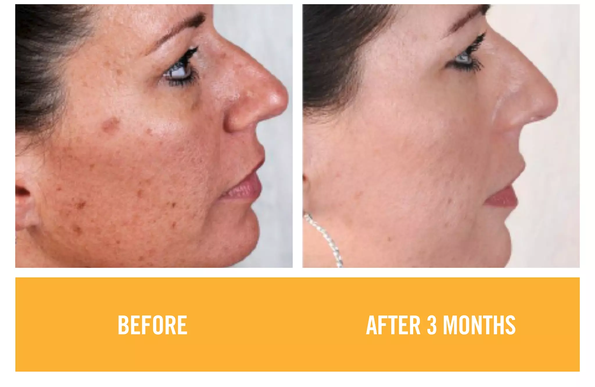 BEFORE AFTER 3 MONTHS
 