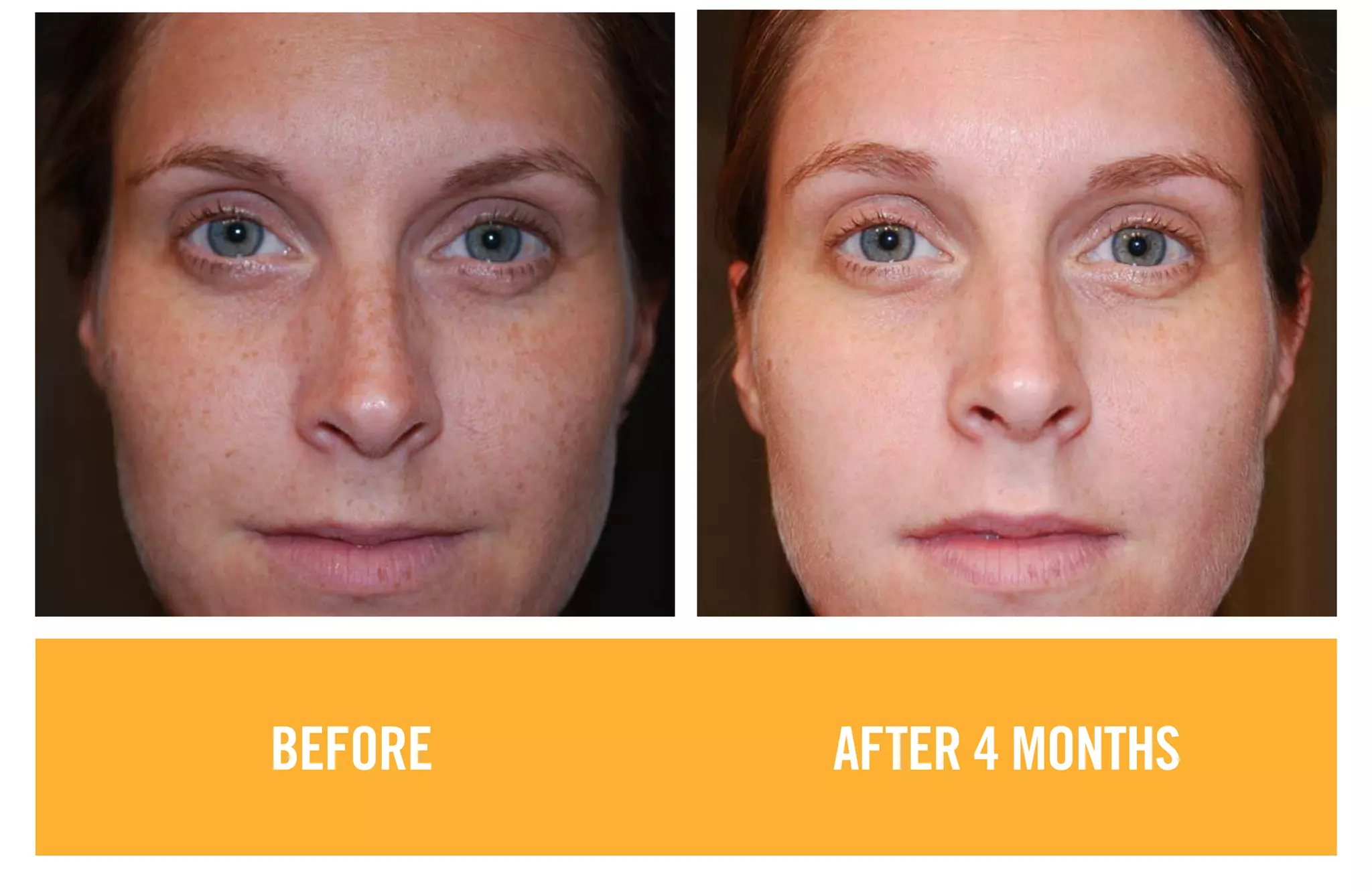 BEFORE AFTER 4 MONTHS
 