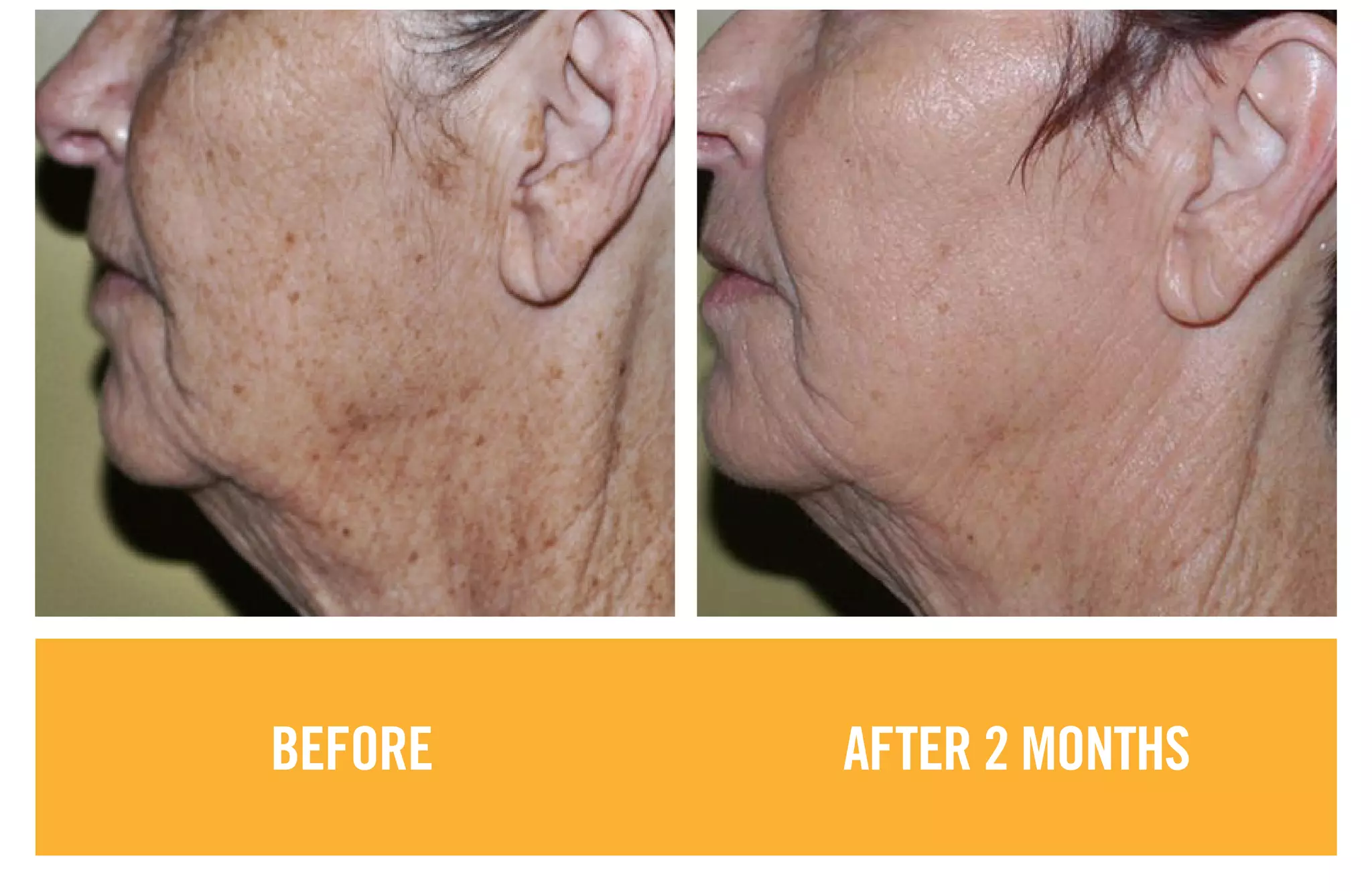 BEFORE AFTER 2 MONTHS
 