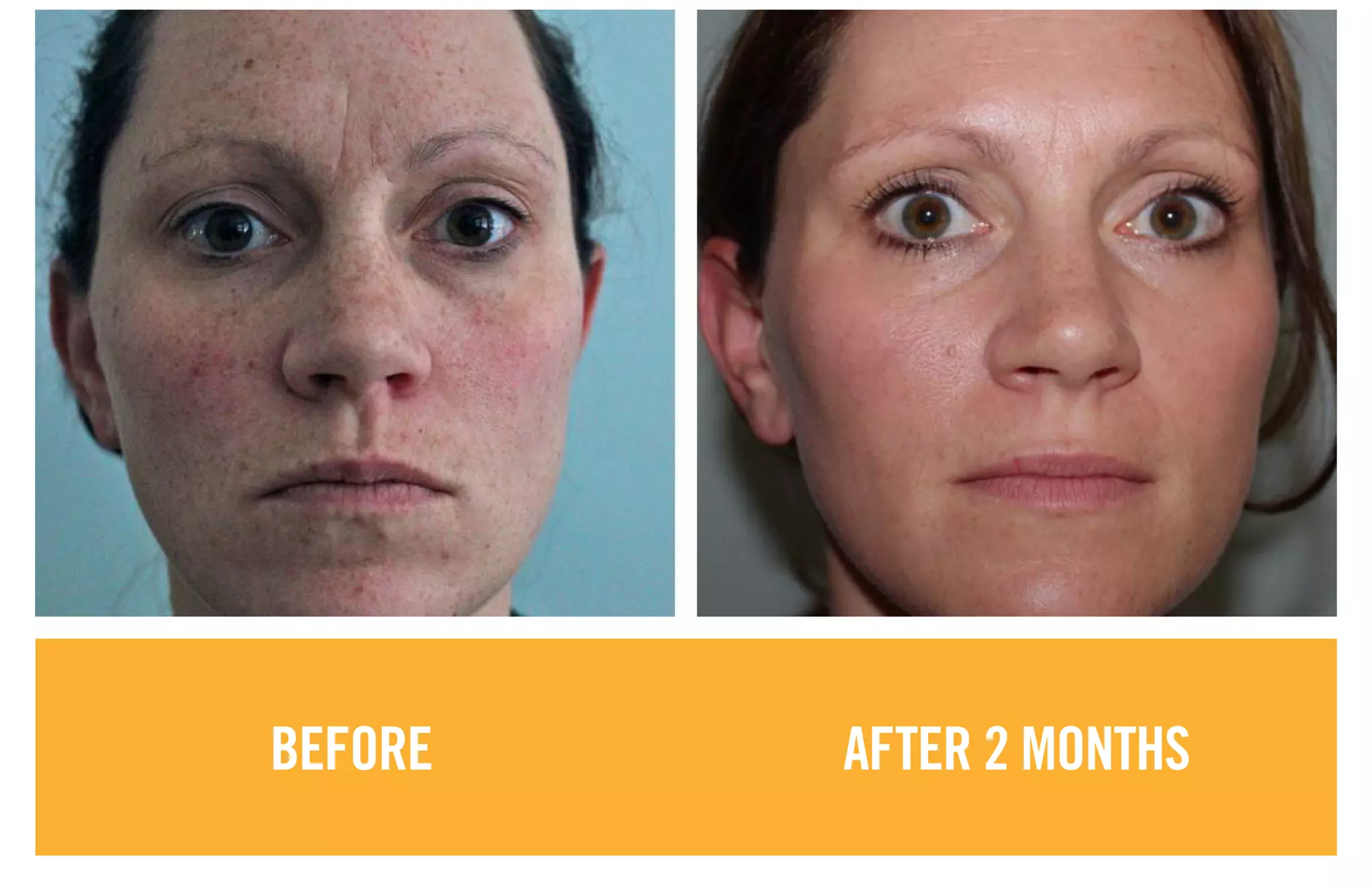 BEFORE AFTER 2 MONTHS
 