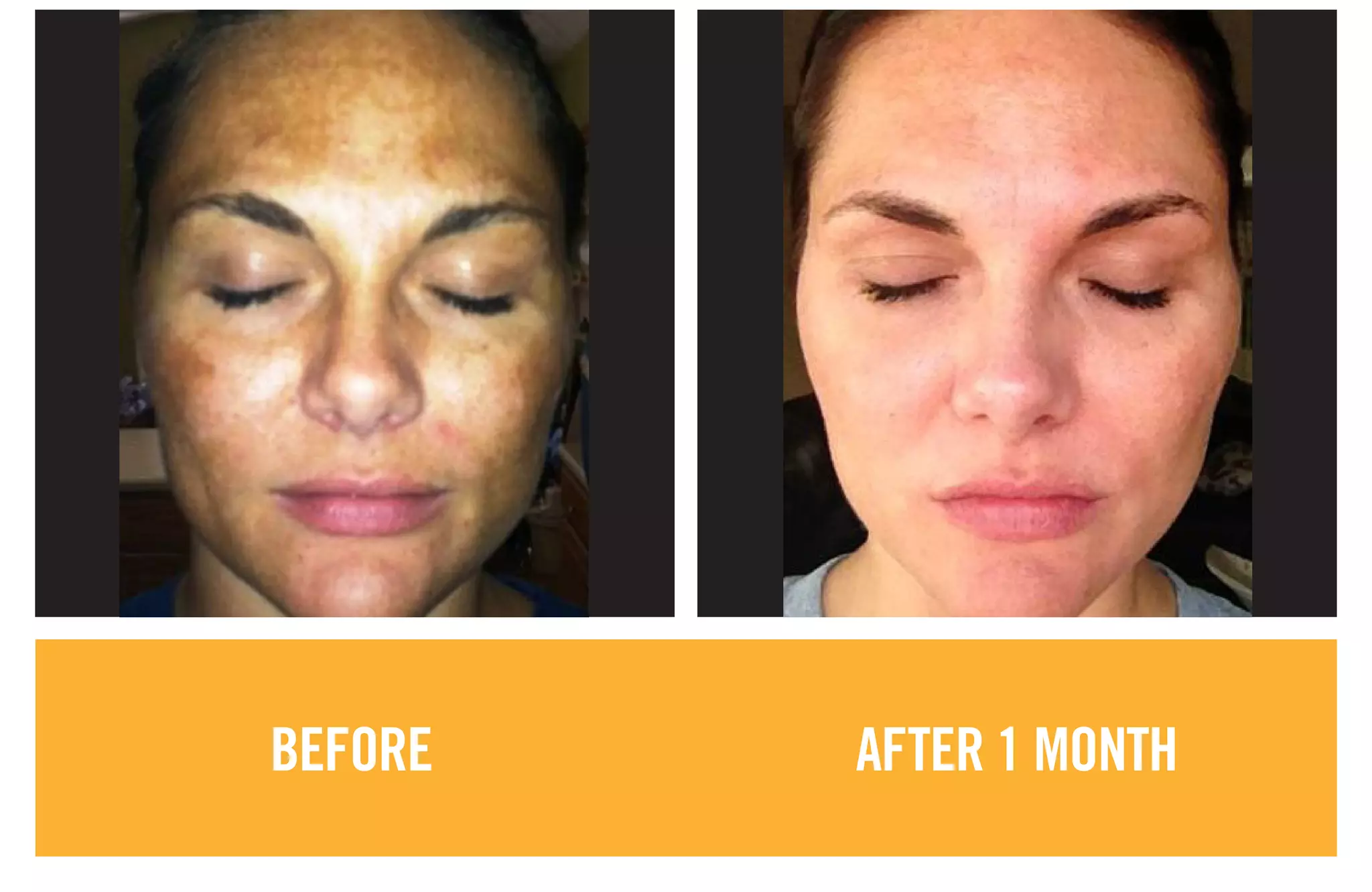 BEFORE AFTER 1 MONTH
 