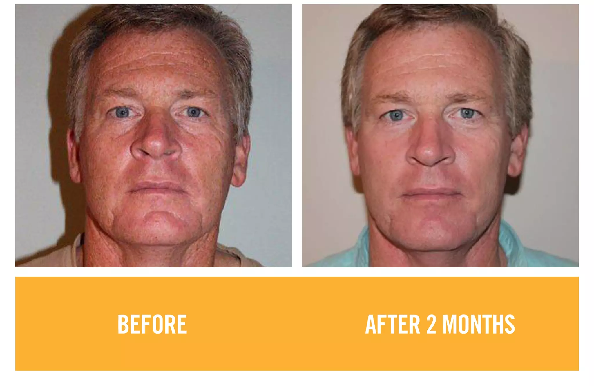 BEFORE AFTER 2 MONTHS
 