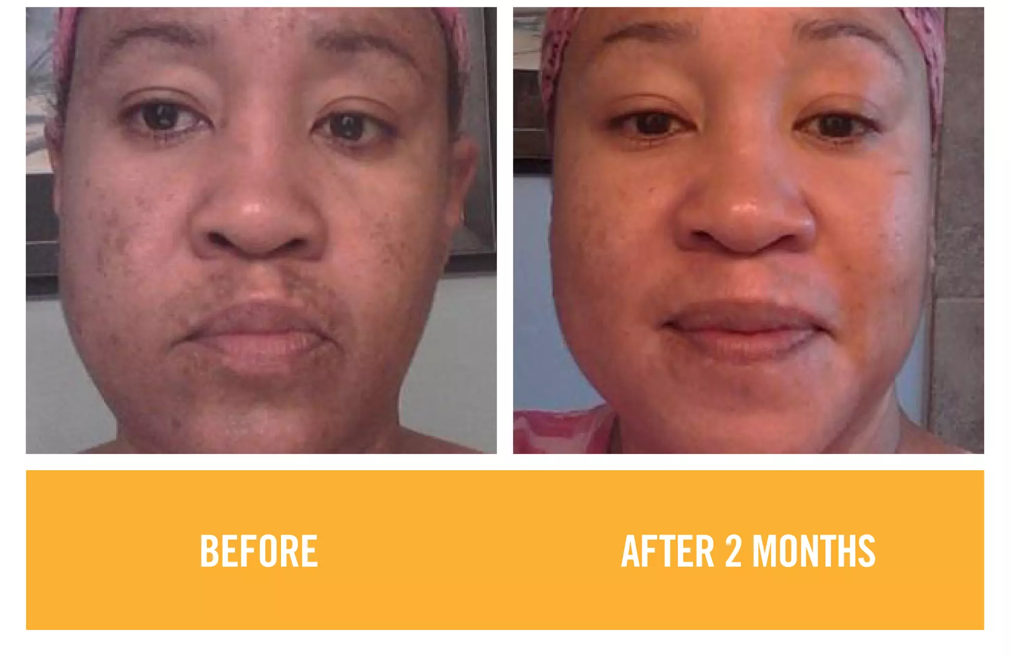 BEFORE AFTER 2 MONTHS
 