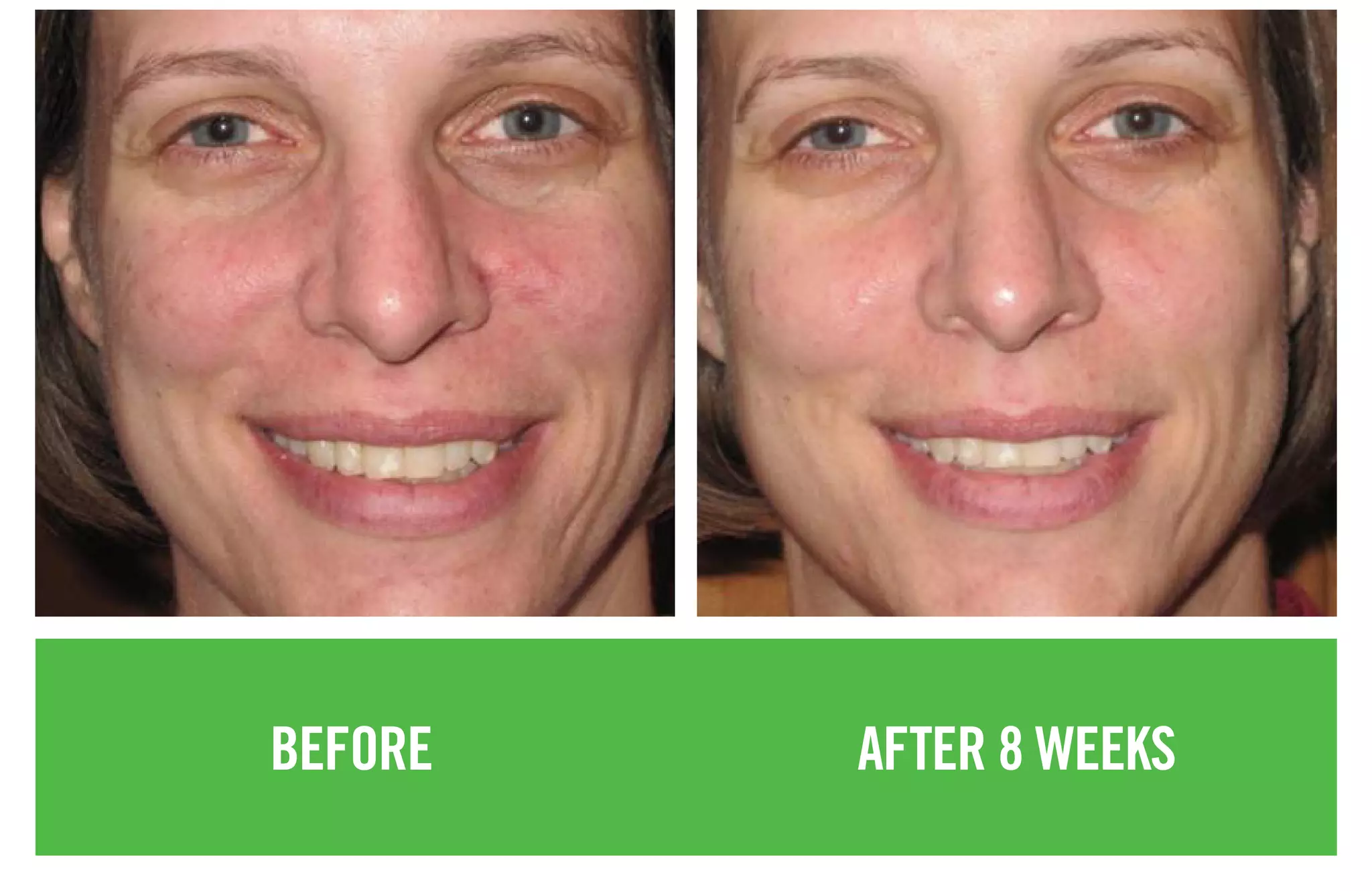 BEFORE AFTER 8 WEEKS
 