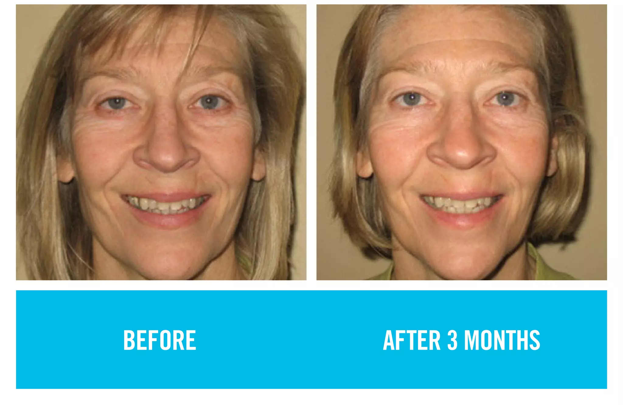 BEFORE AFTER 3 MONTHS
 