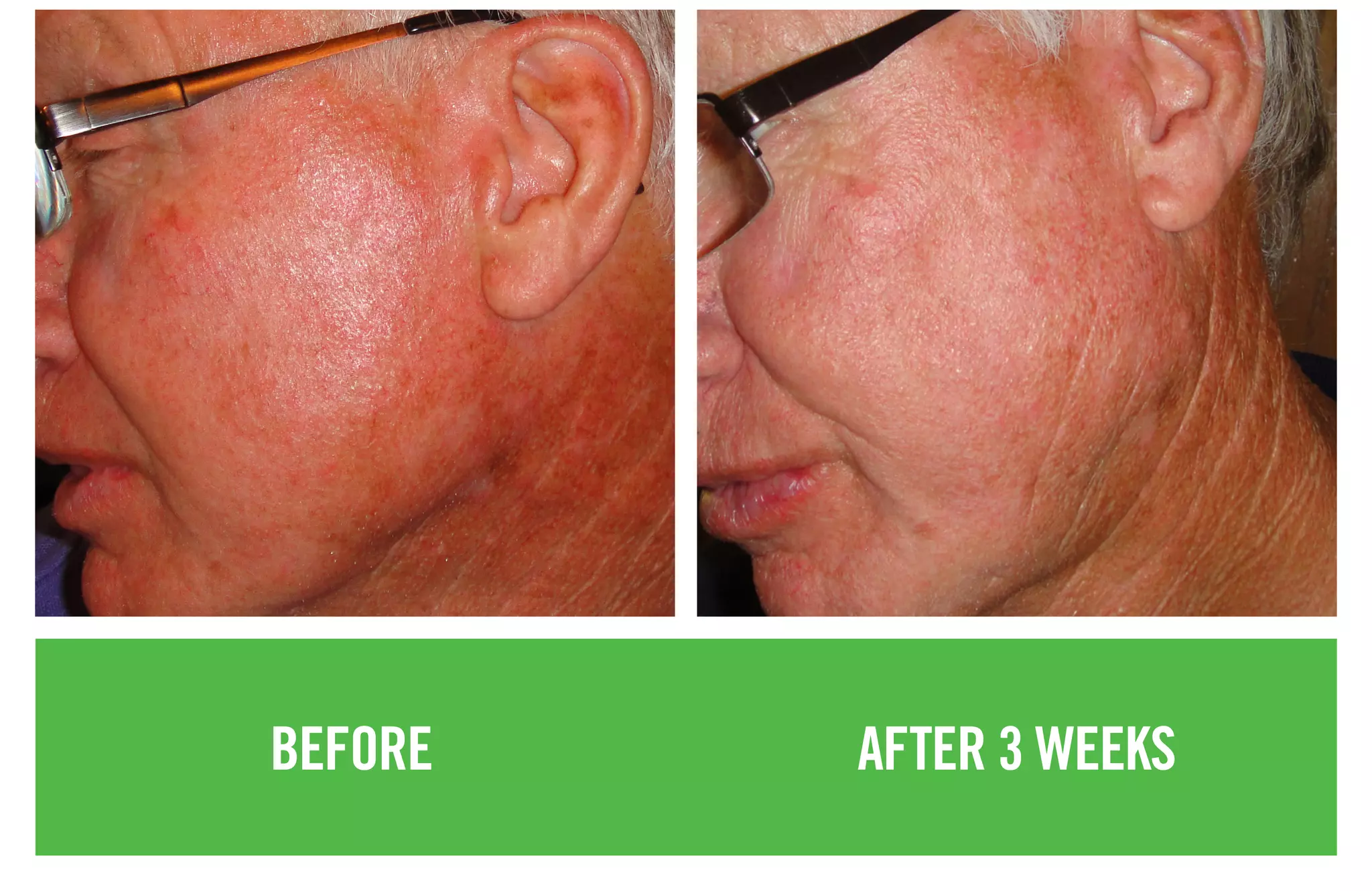 BEFORE AFTER 3 WEEKS
 