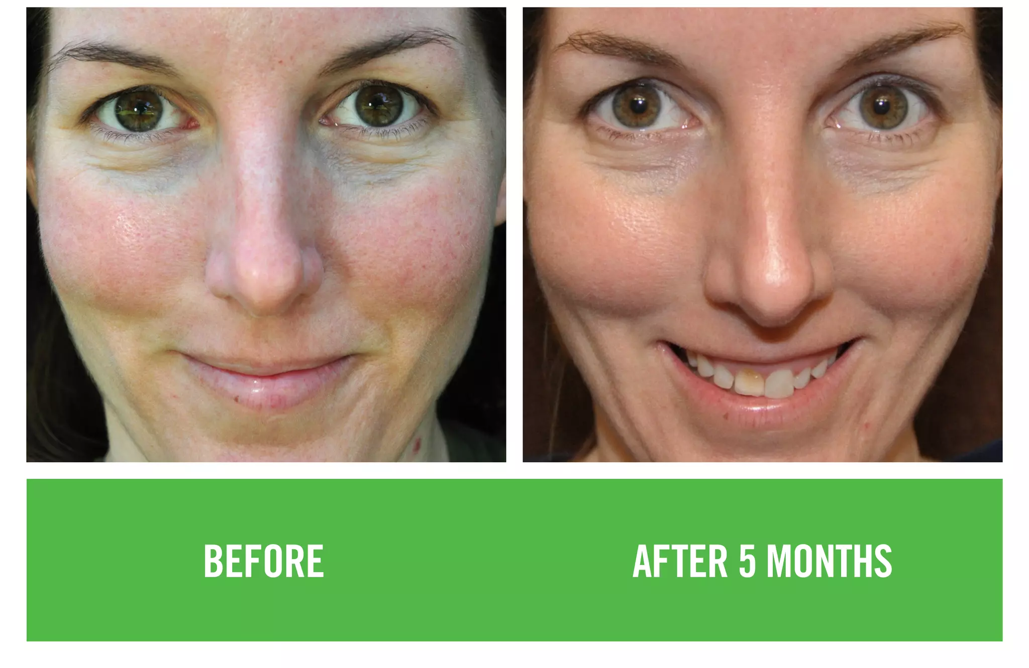 BEFORE AFTER 5 MONTHS
 