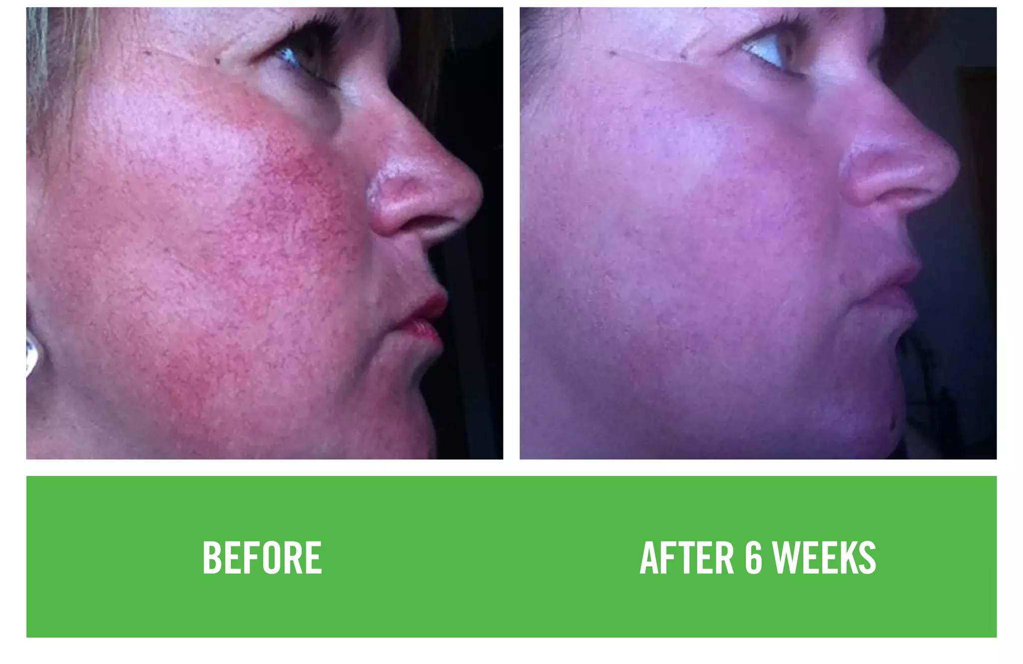 BEFORE AFTER 6 WEEKS
 