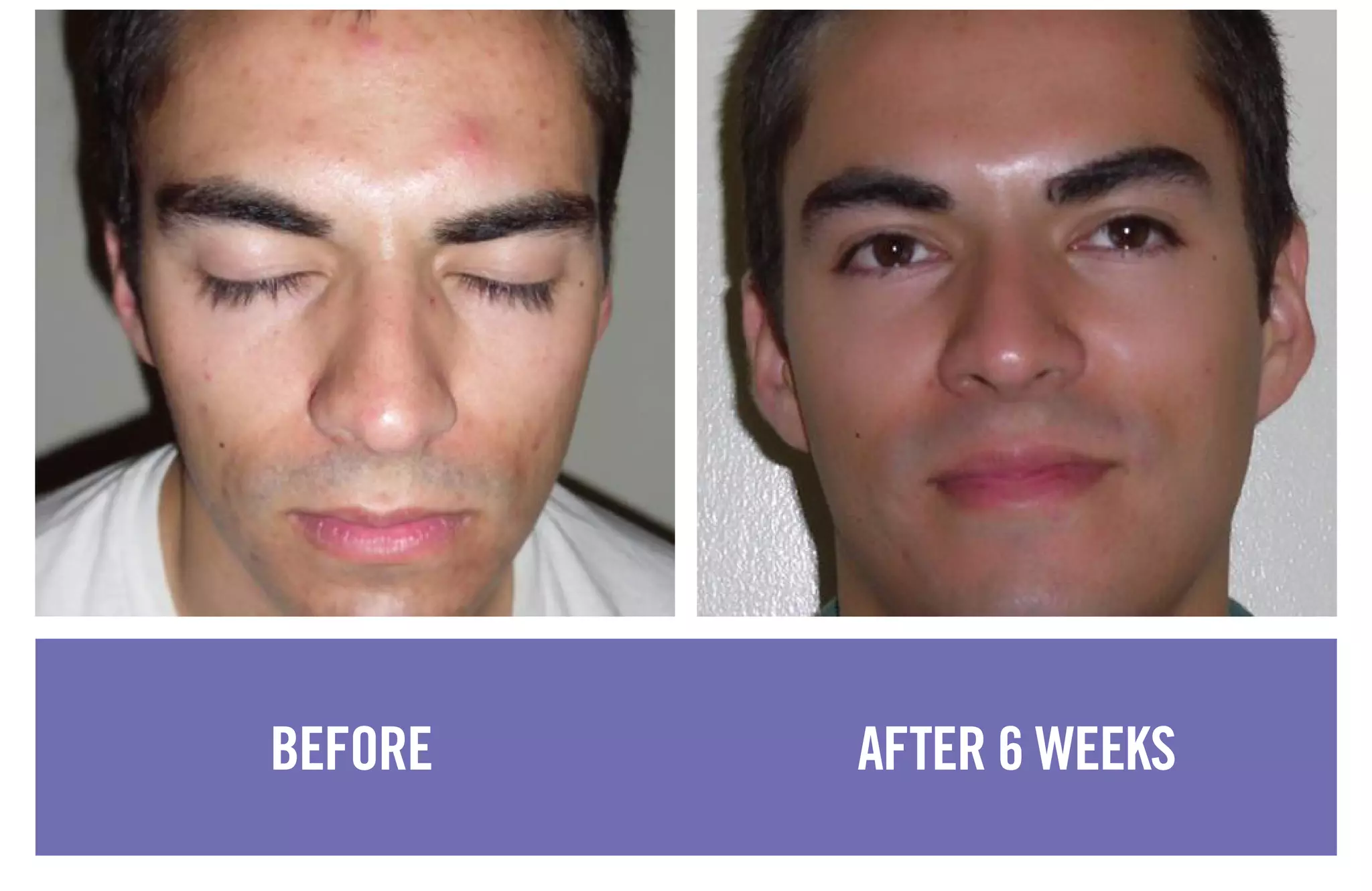 BEFORE AFTER 6 WEEKS
 