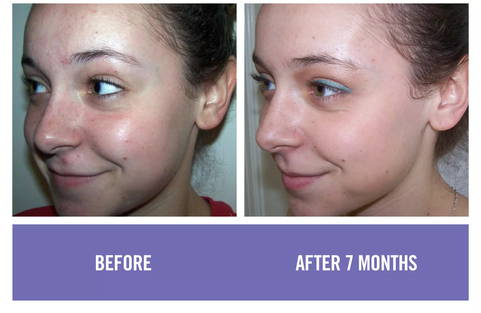 BEFORE AFTER 7 MONTHS
 