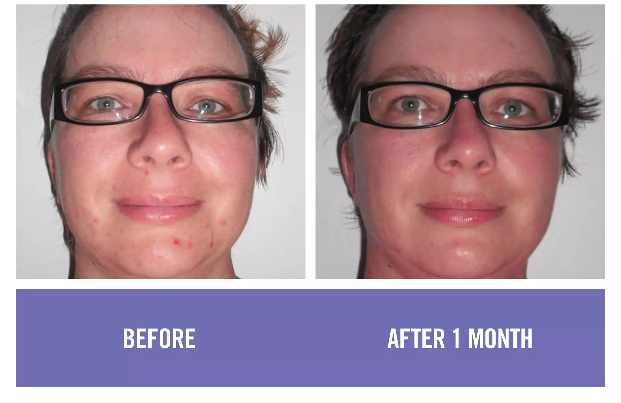 BEFORE AFTER 1 MONTH
 