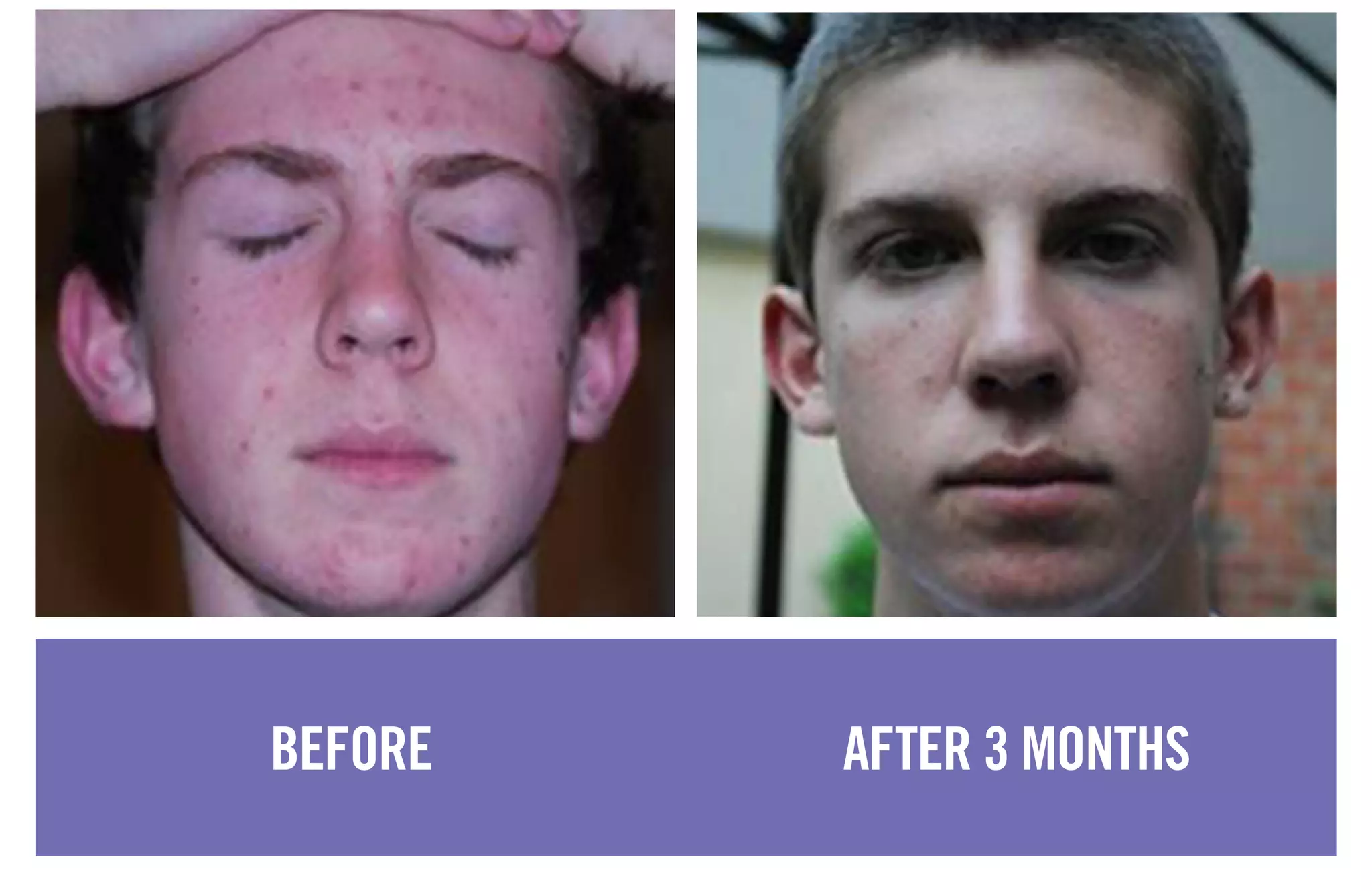 BEFORE AFTER 3 MONTHS
 