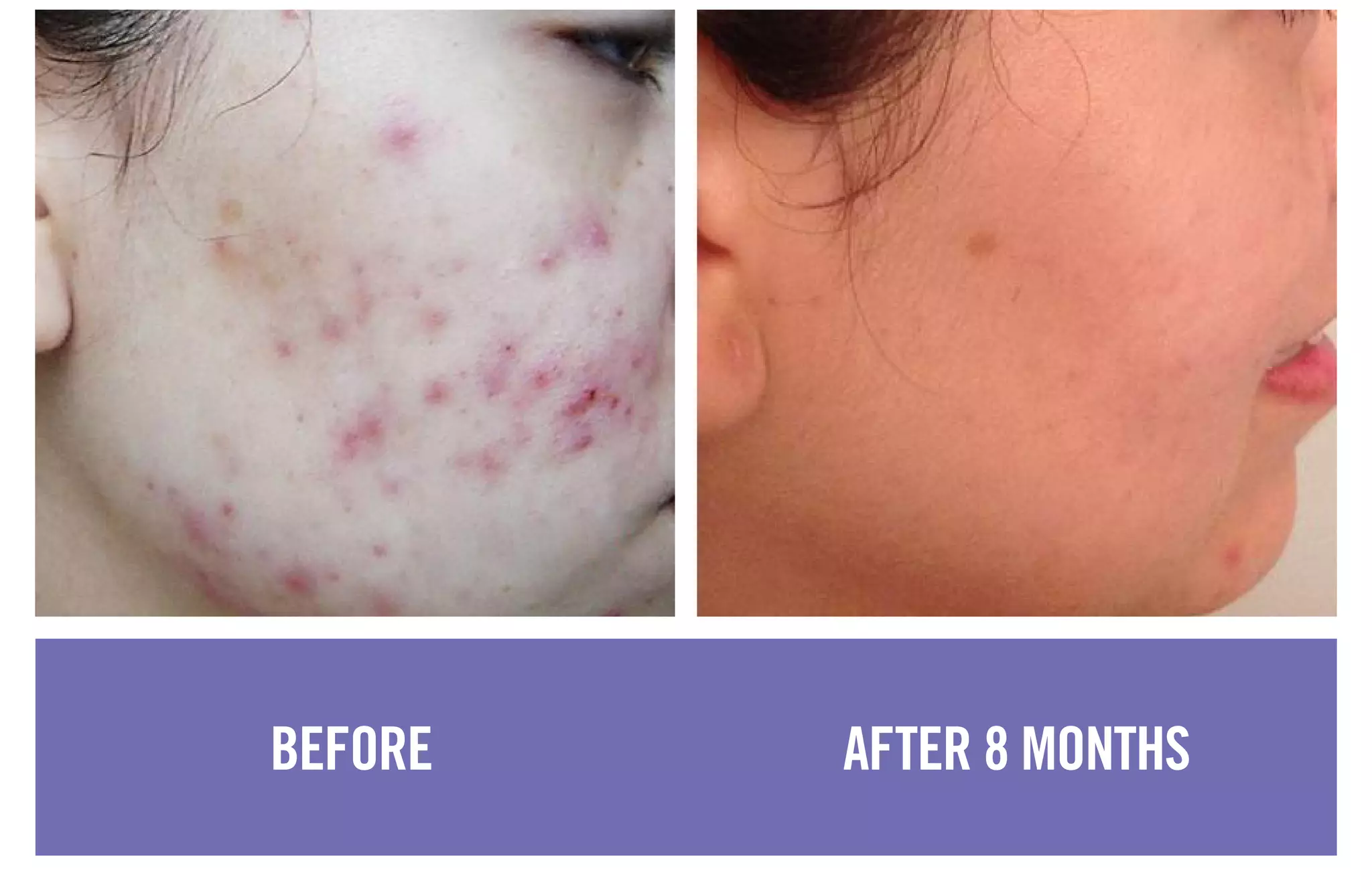 BEFORE AFTER 8 MONTHS
 