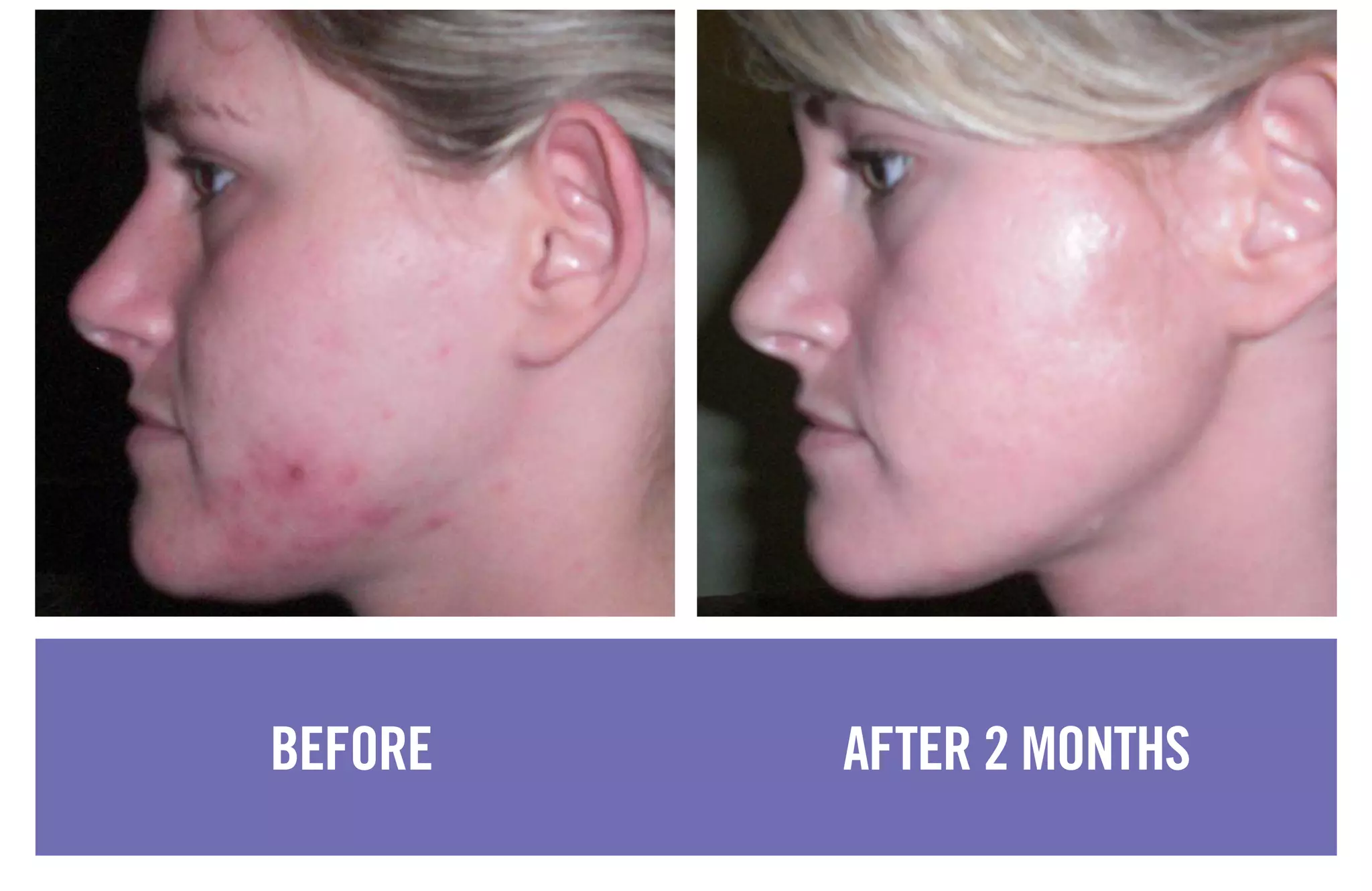 BEFORE AFTER 2 MONTHS
 