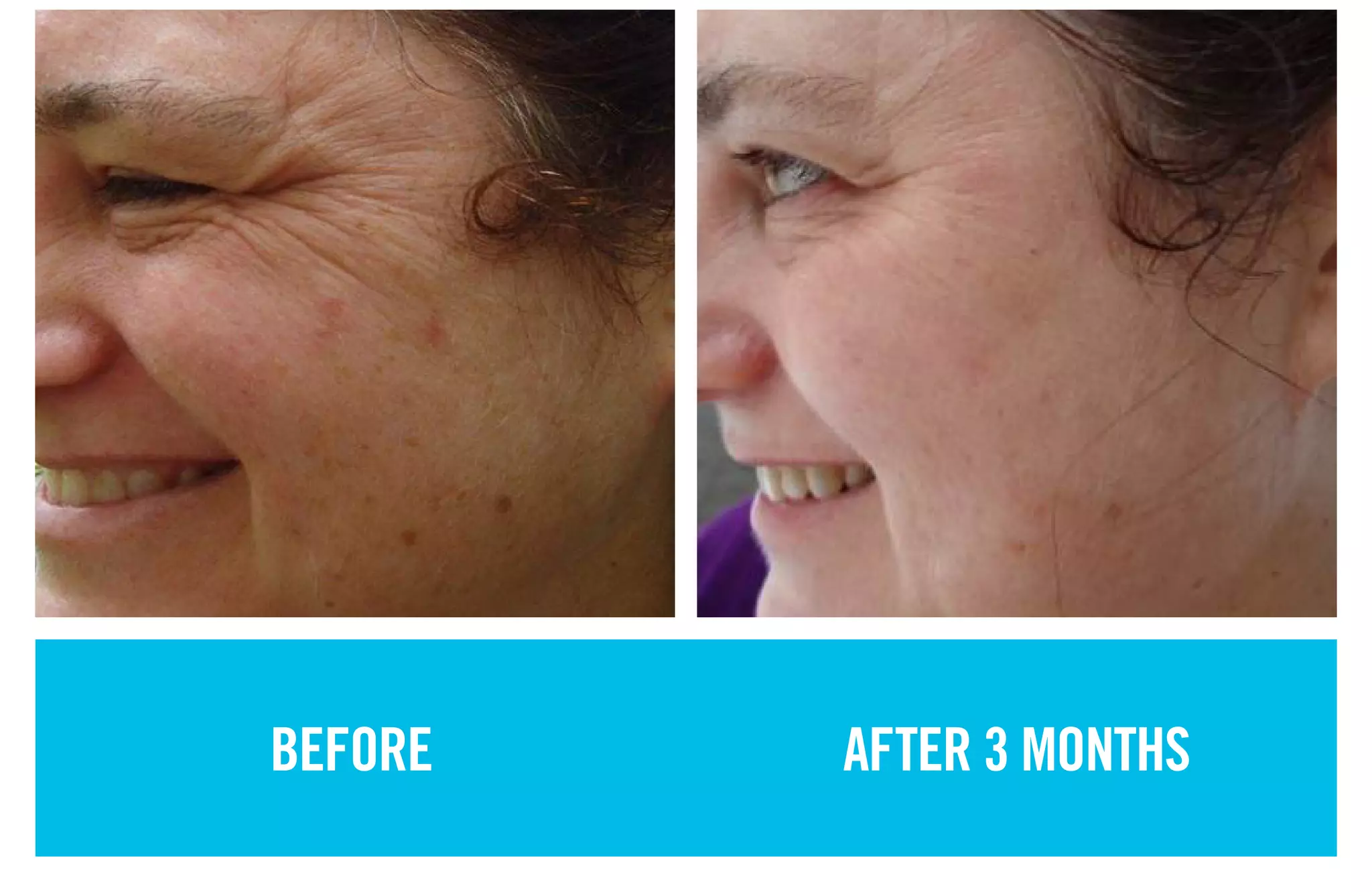 BEFORE AFTER 3 MONTHS
 