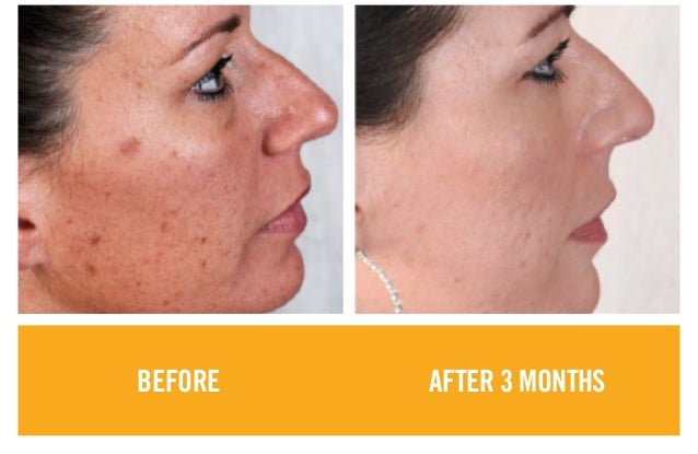 Rodan and Fields Before and After Results