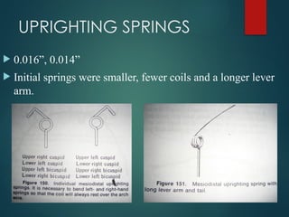 Mini Spring Uprighting Spring beggs treatment mechanics stages.ppt.pptx