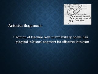 Anterior Segement:Anterior Segement:
• Portion of the wire b/w intermaxillary hooks liesPortion of the wire b/w intermaxillary hooks lies
gingival to buccal segment for effective intrusiongingival to buccal segment for effective intrusion
 