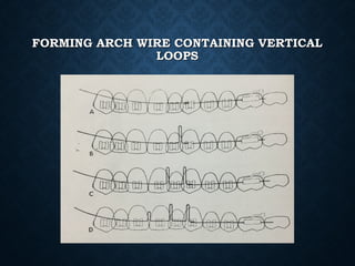 FORMING ARCH WIRE CONTAINING VERTICALFORMING ARCH WIRE CONTAINING VERTICAL
LOOPSLOOPS
 