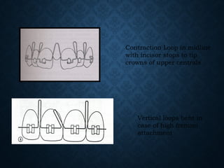 Contraction Loop in midline
with incisor stops to tip
crowns of upper centrals
Vertical loops bent in
case of high frenum
attachment
 
