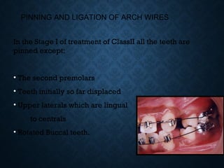 PINNING AND LIGATION OF ARCH WIRES
In the Stage I of treatment of ClassII all the teeth are
pinned except:
• The second premolars
• Teeth initially so far displaced
• Upper laterals which are lingual
to centrals
• Rotated Buccal teeth.
 