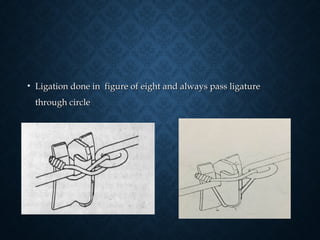 • Ligation done in figure of eight and always pass ligatureLigation done in figure of eight and always pass ligature
through circlethrough circle
 